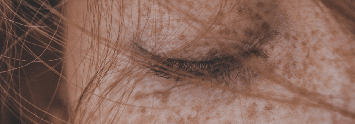 What is Bimatoprost and Why Should You Avoid It? - ForChics